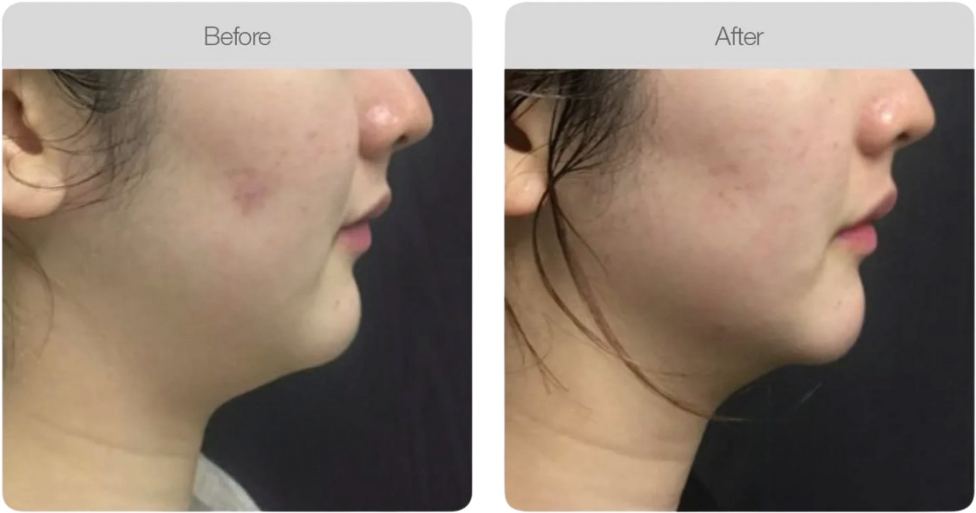 Clarity & Even Tone — before and after