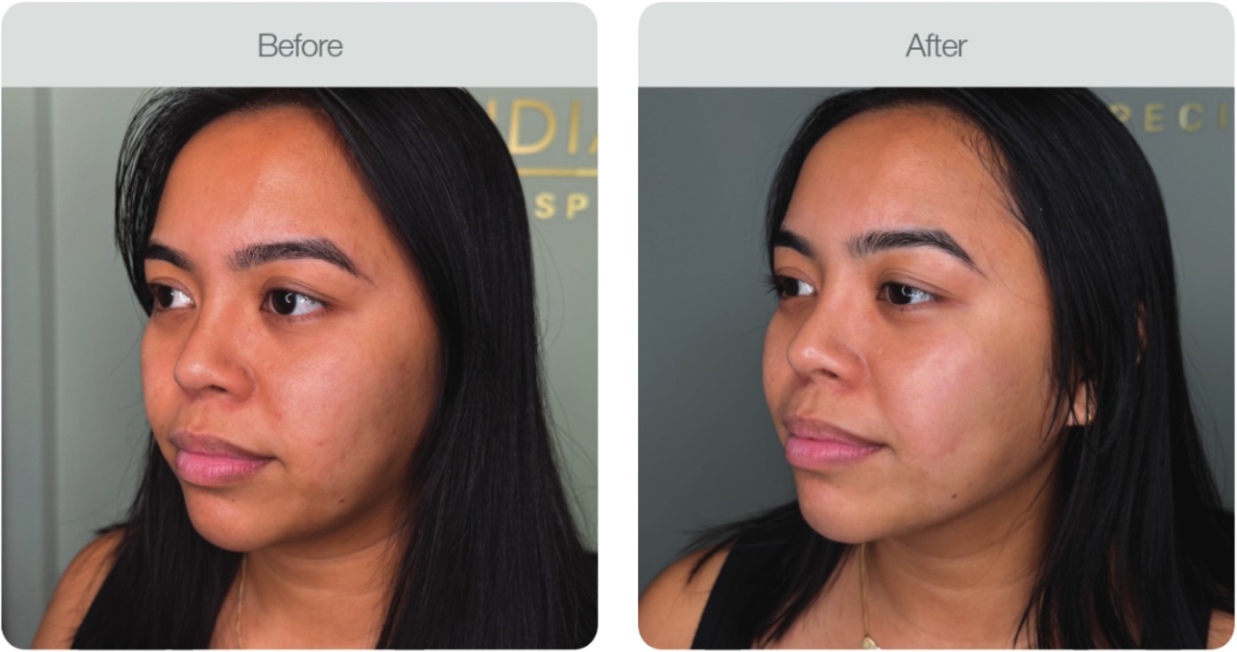 Pigmentation & Breakouts — before and after