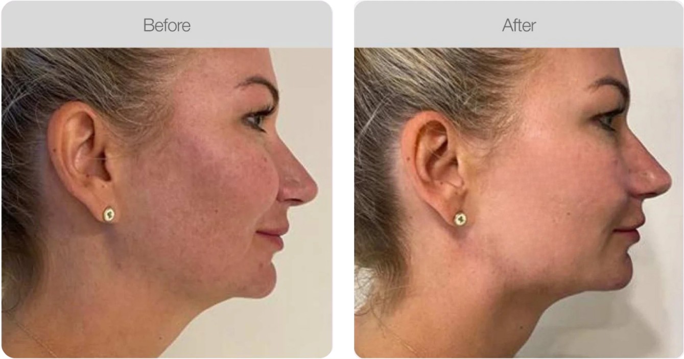 Jawline Definition — before and after