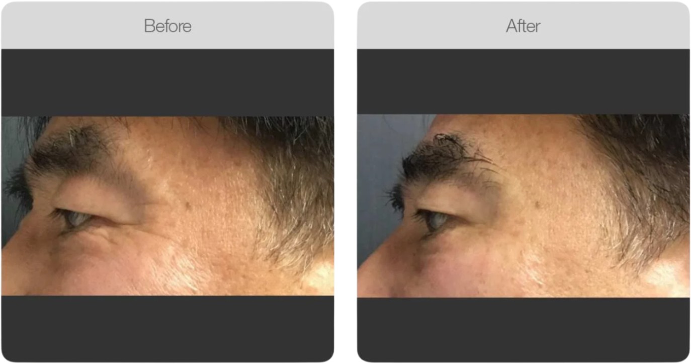 Eye Area Rejuvenation — before and after