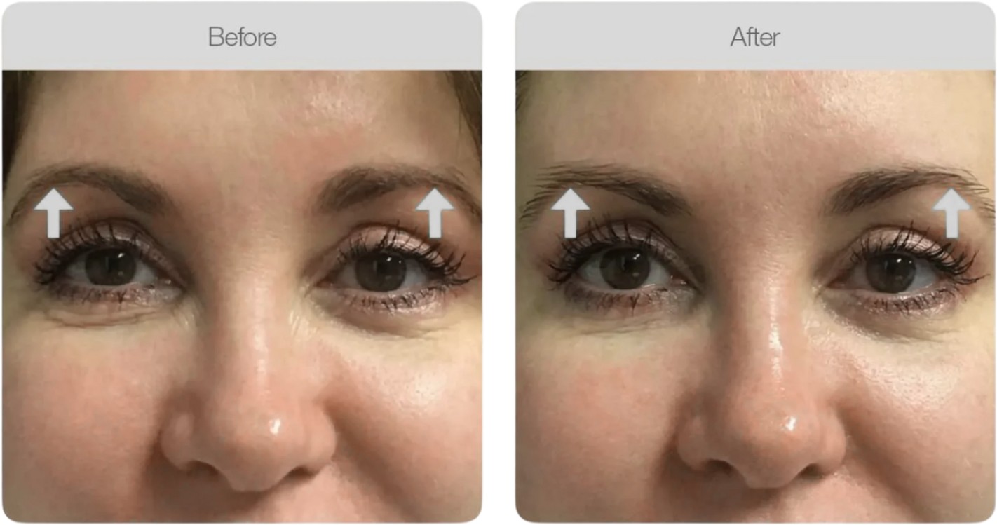 Under-Eye Brightening — before and after
