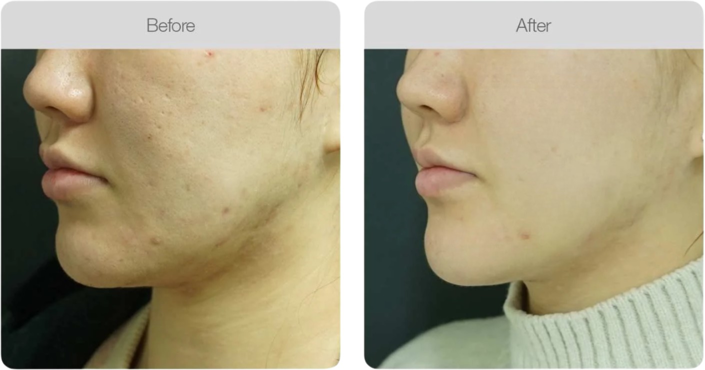 Acne Scarring & Texture — before and after